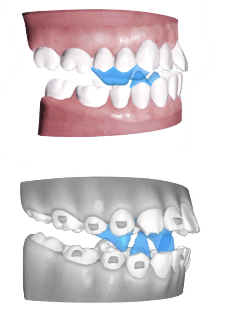Produktbilder - A6-Mandibuläre Protrusionslösung
